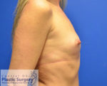 Breast Augmentation