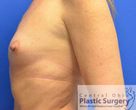 Breast Augmentation