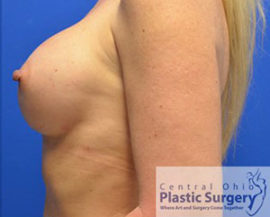 Breast Augmentation