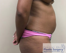 Liposuction