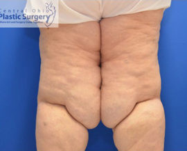 Liposuction