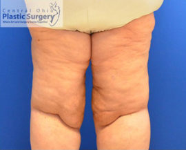 Liposuction