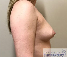 Breast Augmentation