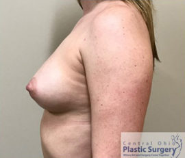 Breast Augmentation