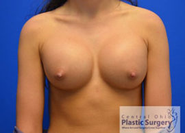 Breast Augmentation