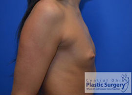 Breast Augmentation