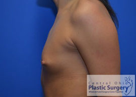 Breast Augmentation