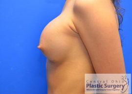 Breast Augmentation