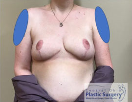Breast Reduction/Breast Lift