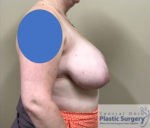 Breast Reduction/Breast Lift