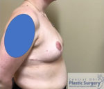 Breast Reduction/Breast Lift