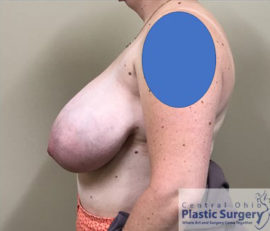 Breast Reduction/Breast Lift