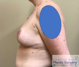 Breast Reduction/Breast Lift
