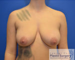 Breast Augmentation