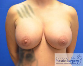 Breast Augmentation