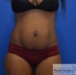 Tummy Tuck