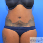 Tummy Tuck