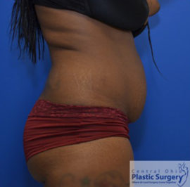 Tummy Tuck