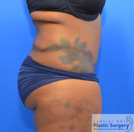 Tummy Tuck