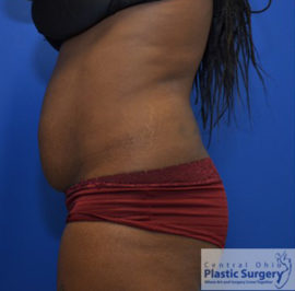 Tummy Tuck