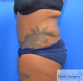 Tummy Tuck