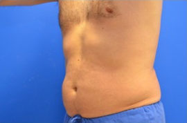 Coolsculpting