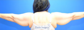 Coolsculpting