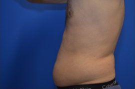 Coolsculpting