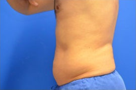 Coolsculpting