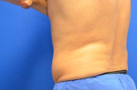 Coolsculpting