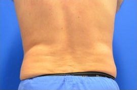 Coolsculpting