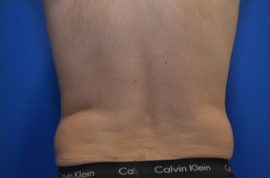 Coolsculpting