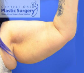 Coolsculpting