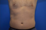 Coolsculpting