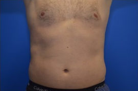 Coolsculpting