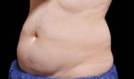 Coolsculpting