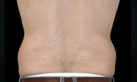 Coolsculpting