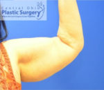 Coolsculpting