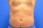 Coolsculpting