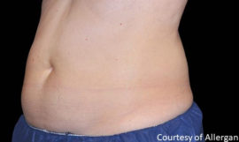 Coolsculpting