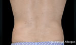 Coolsculpting