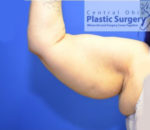 Coolsculpting