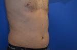 Coolsculpting