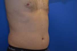 Coolsculpting