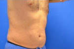 Coolsculpting