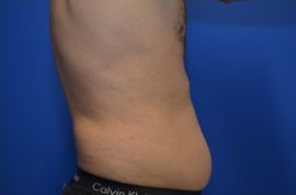 Coolsculpting