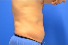 Coolsculpting