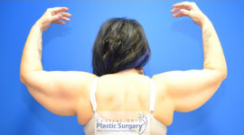 Coolsculpting