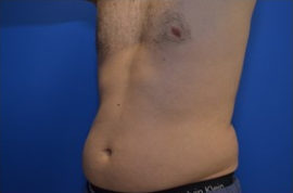 Coolsculpting