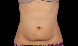 Coolsculpting